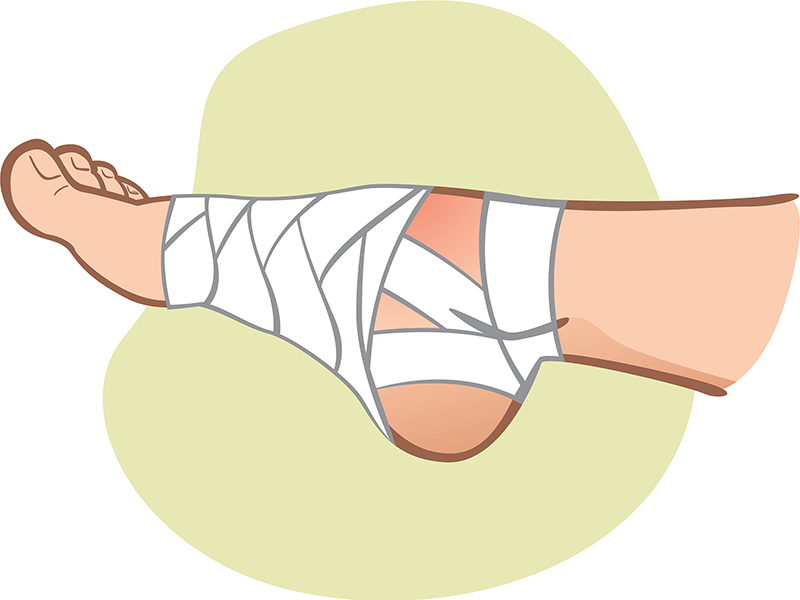 什么是踝关节扭伤