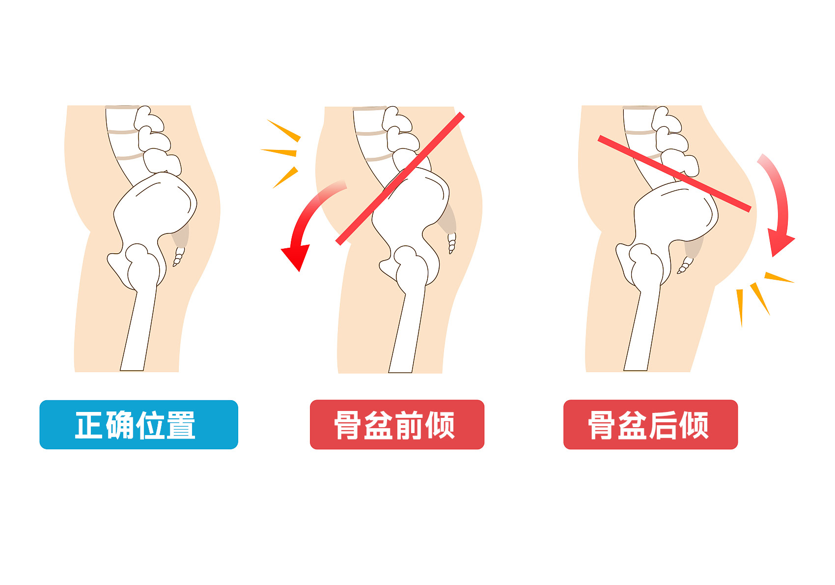 什么是产后骨盆矫正