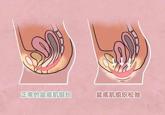 产后便秘很严重，去盆底肌找找原因吧