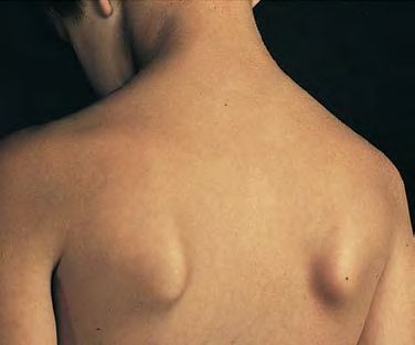 翼状肩怎么办？