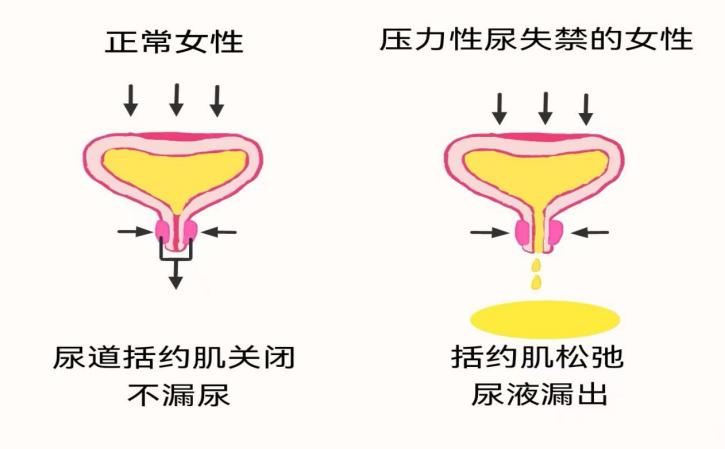 盆底肌损伤康复的重要性