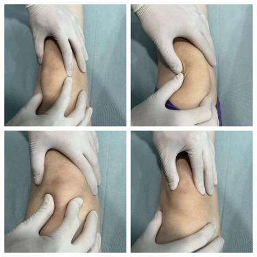 前交叉韧带断裂术后康复训练