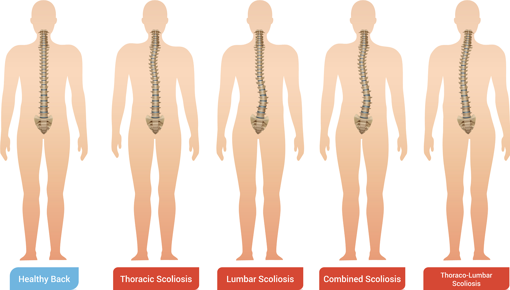 脊柱侧弯的专业评估