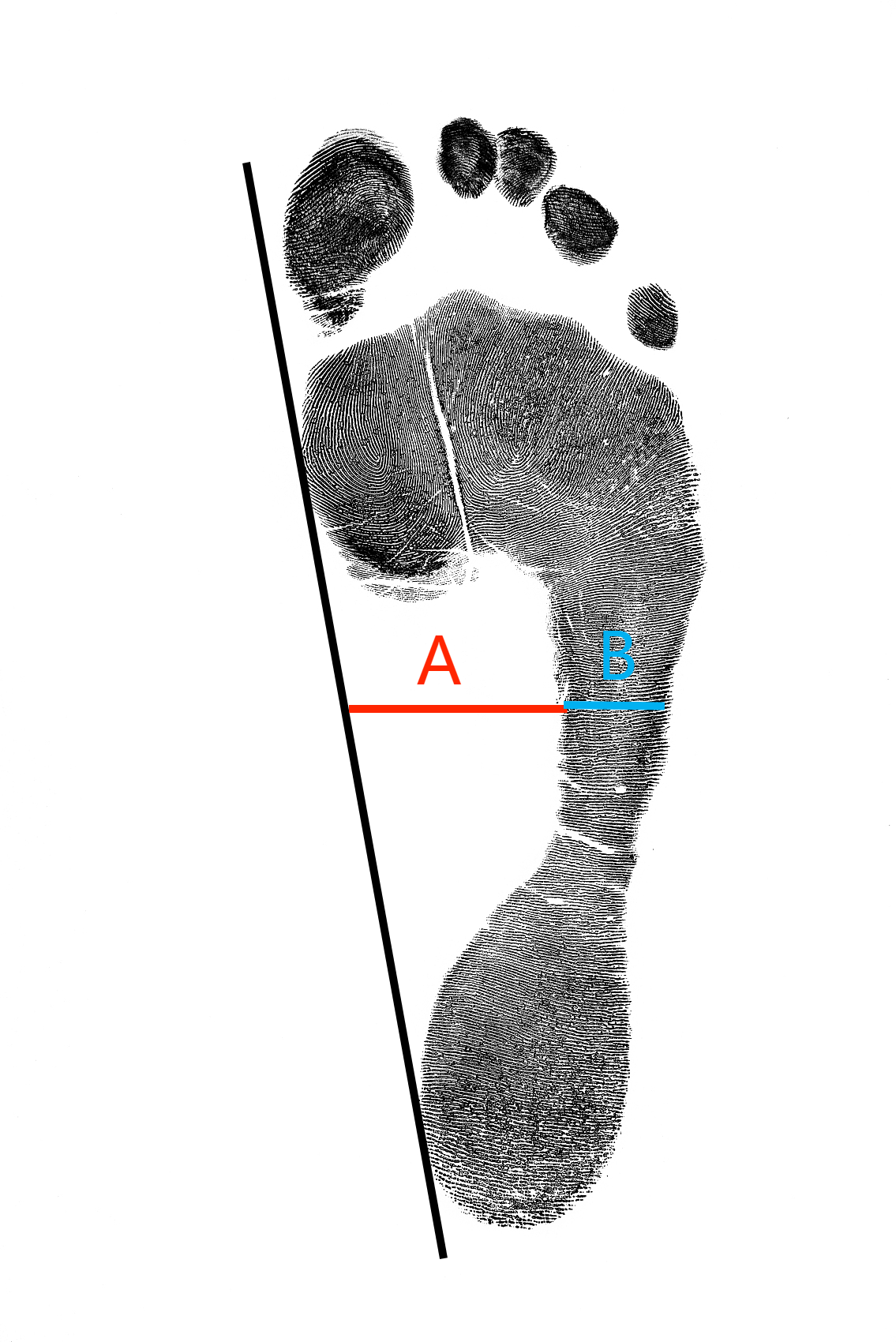 如何评估扁平足