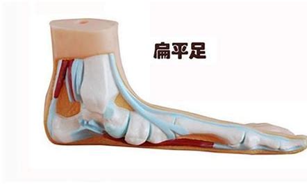 做足功课，认识扁平足