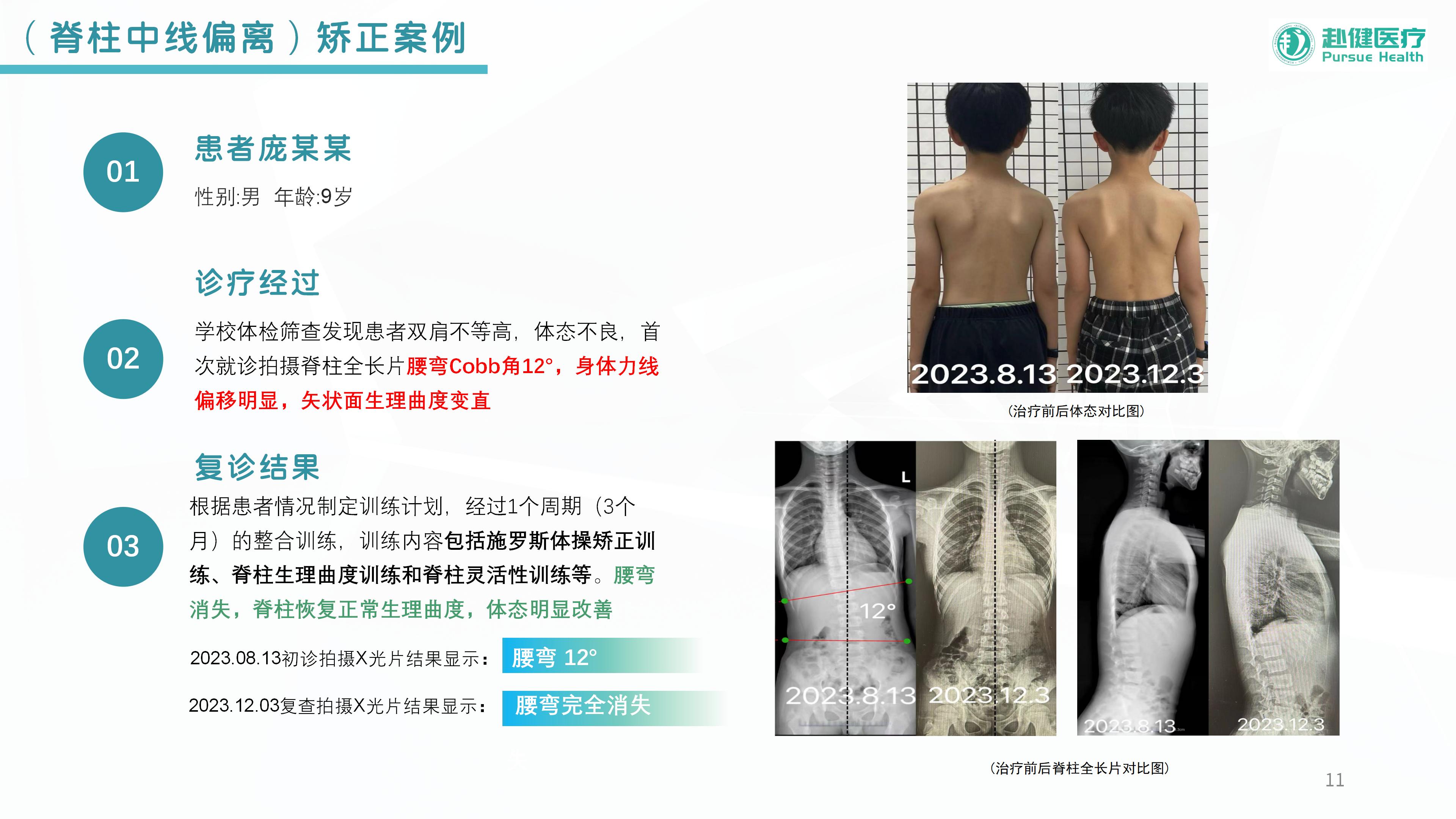 （脊柱中线偏离）矫正案例