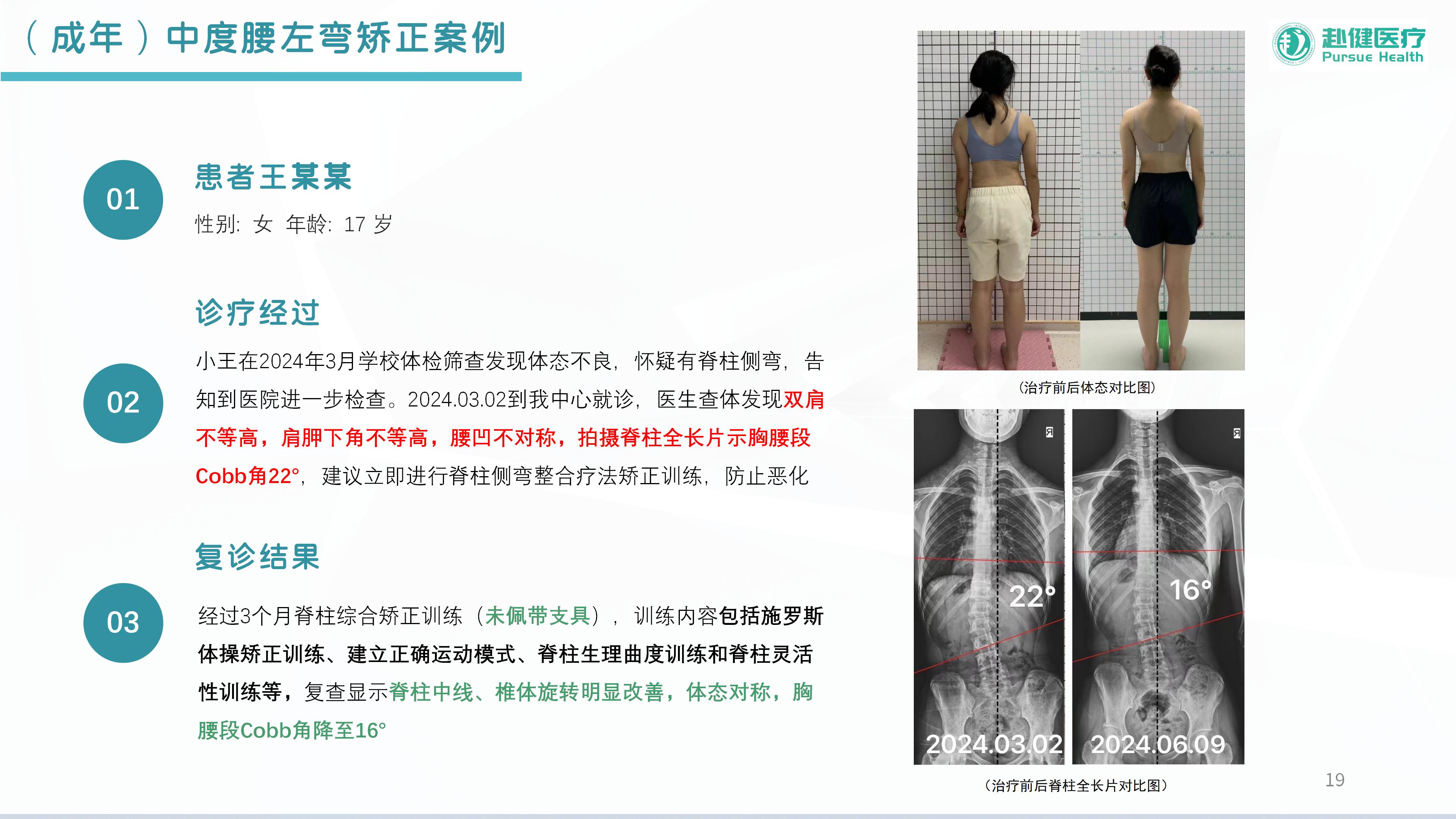 （成年）中度腰左弯矫正案例
