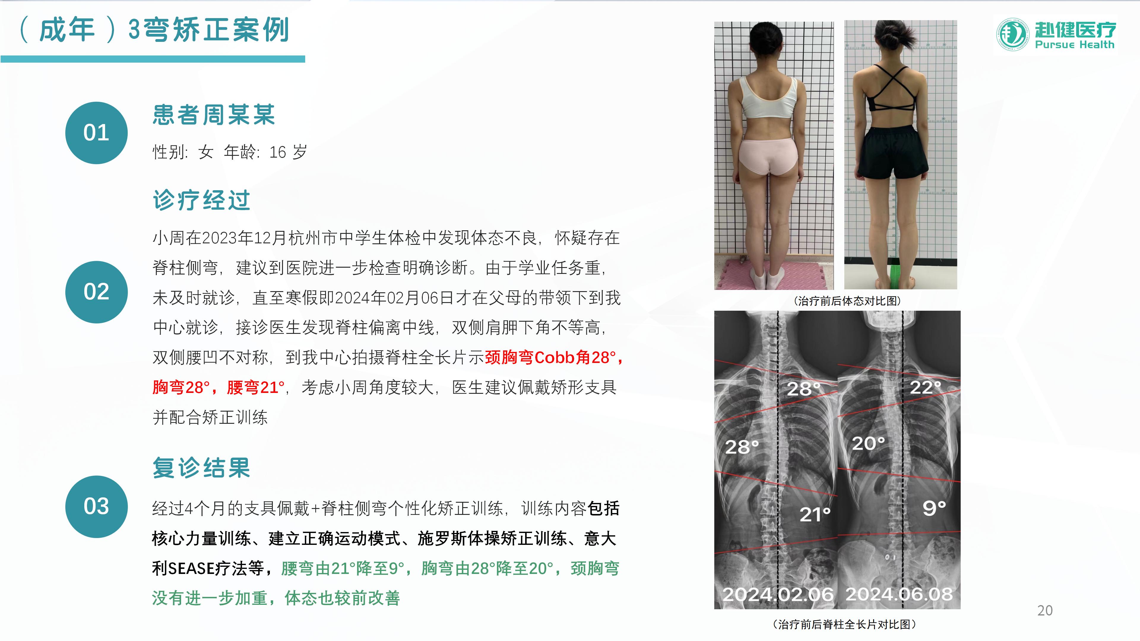 成年（S弯）矫正案例