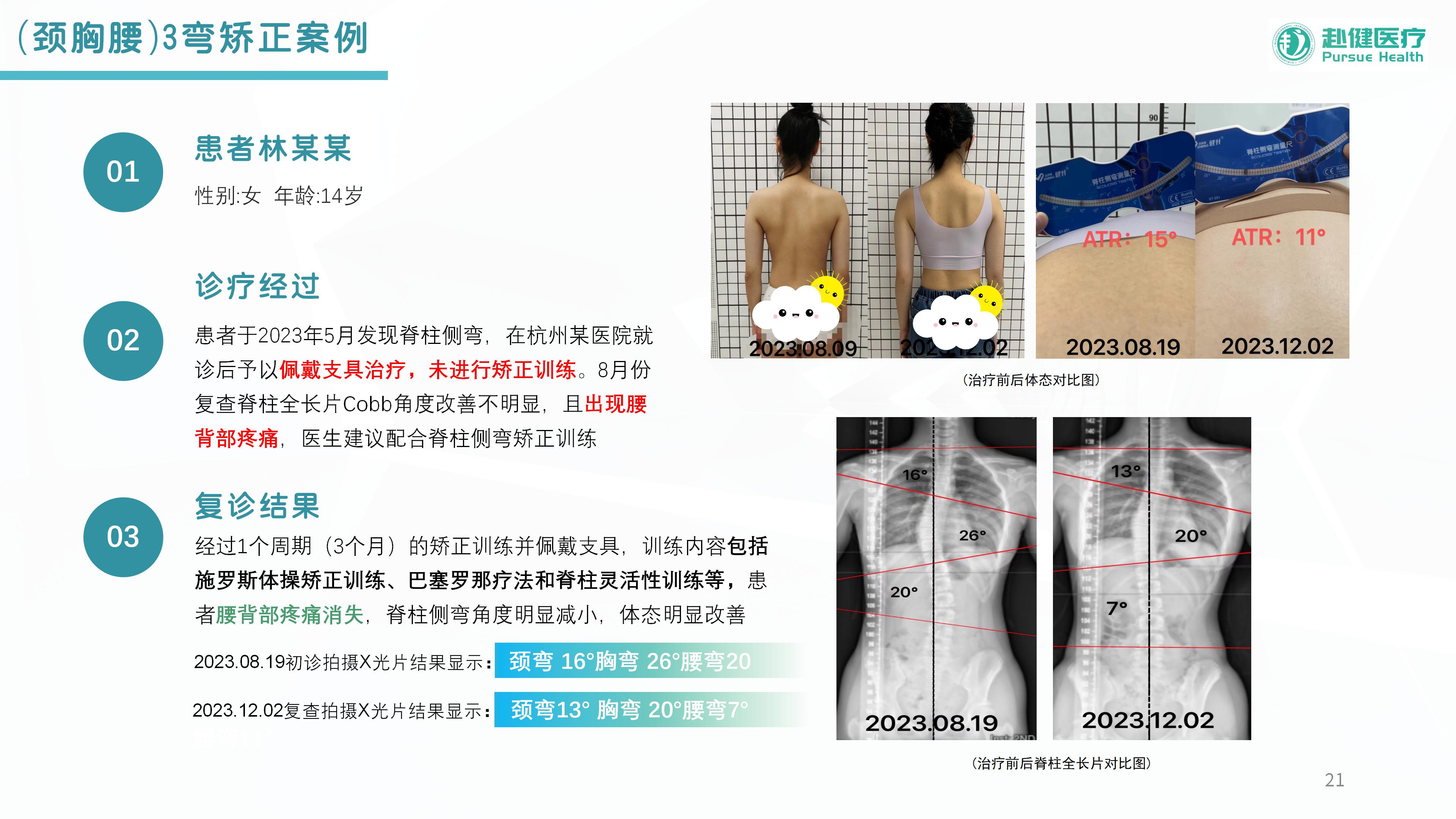 （颈胸腰）S弯矫正案例