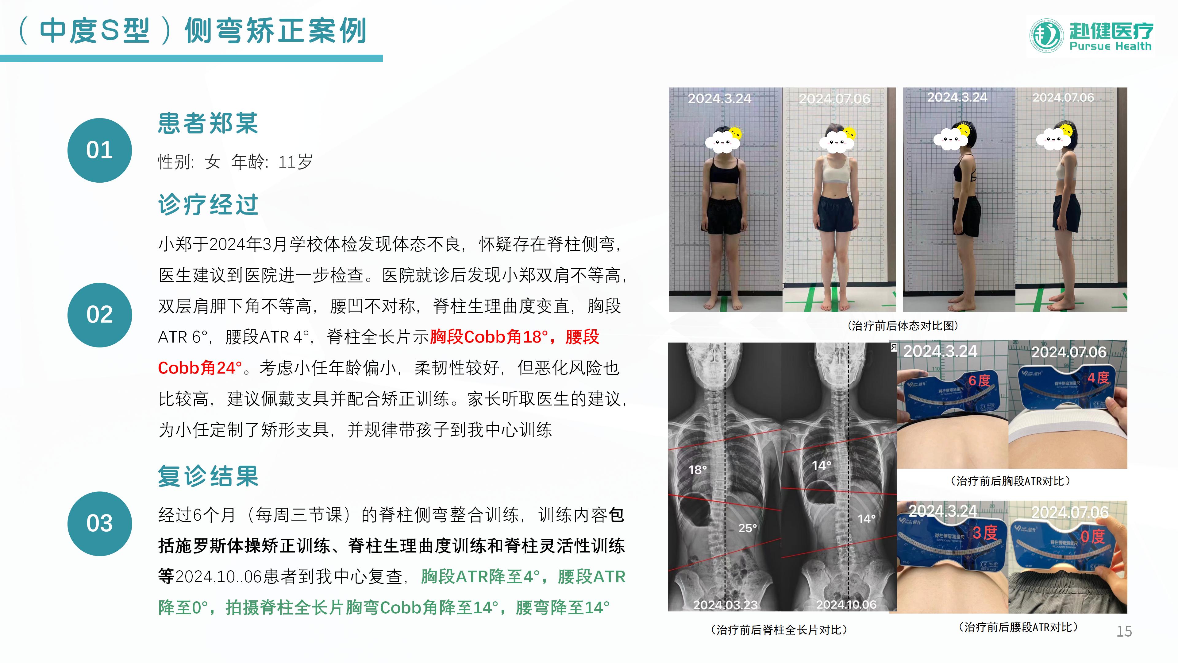 （中度S型）侧弯矫正案例