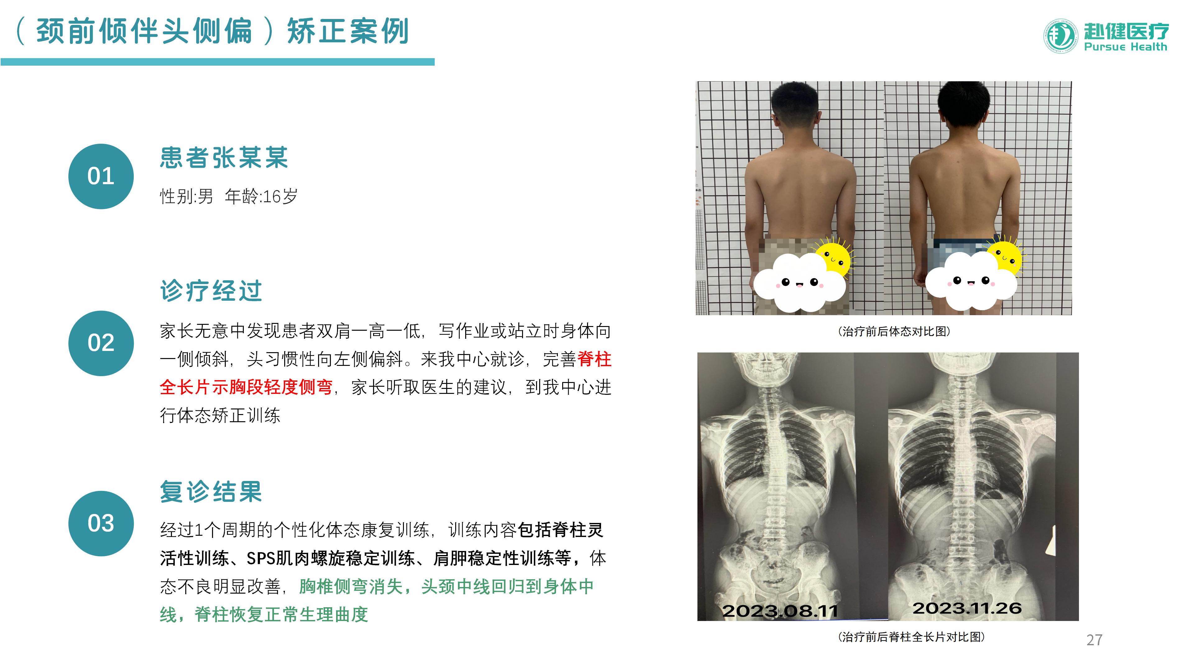 （颈前倾伴头侧偏）矫正案例