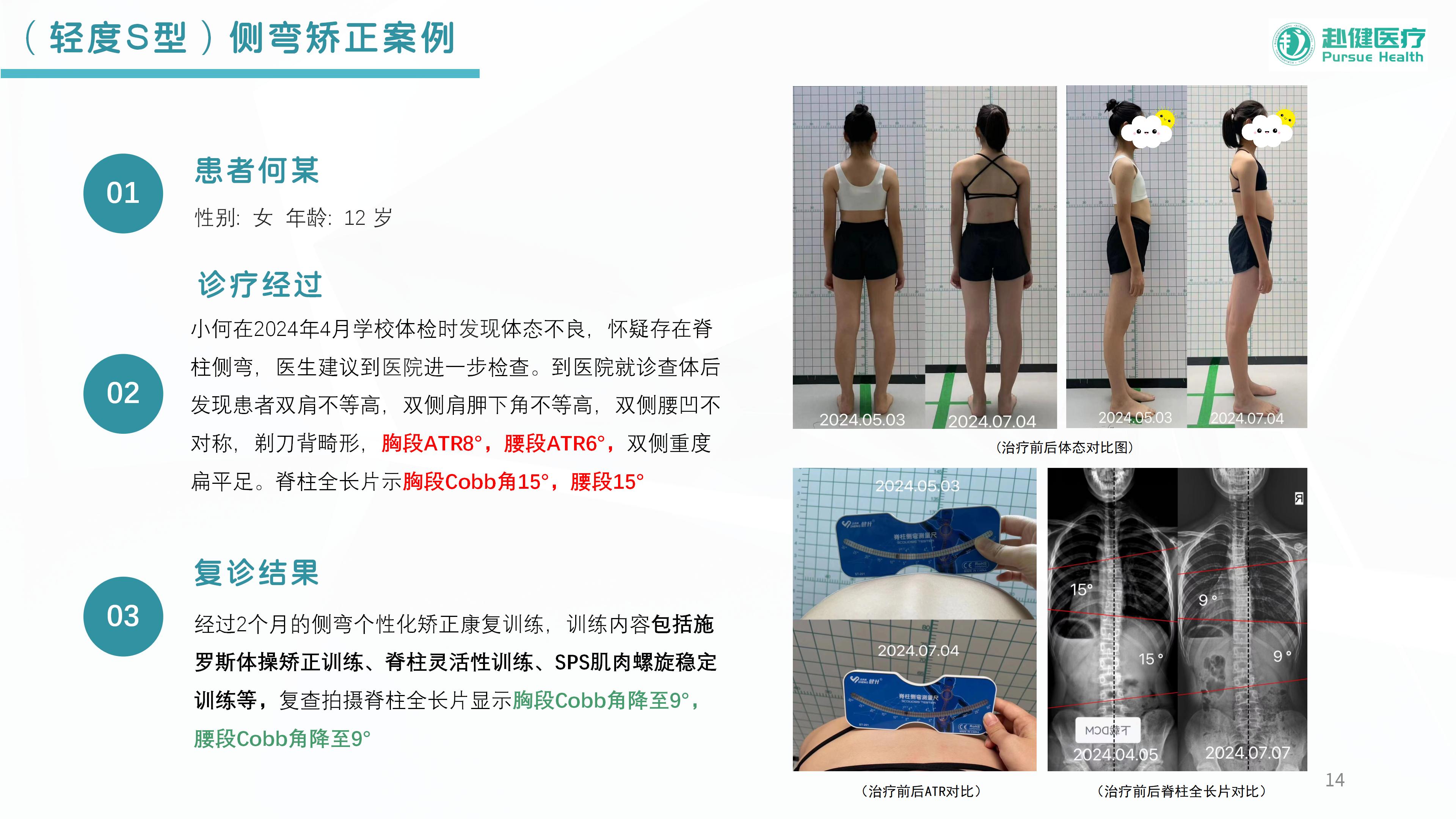 （轻度S型）侧弯矫正案例