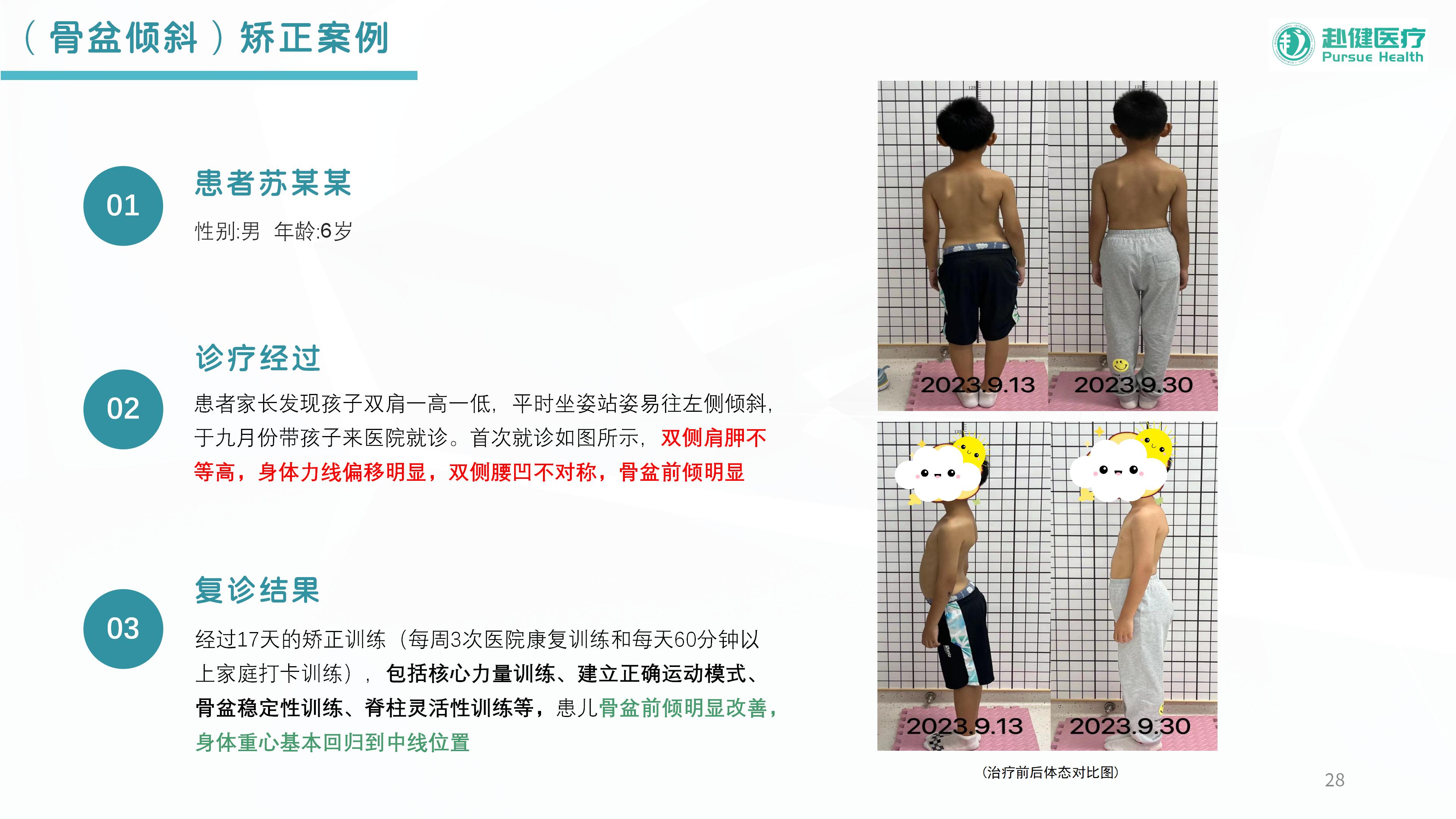 （骨盆倾斜）矫正案例
