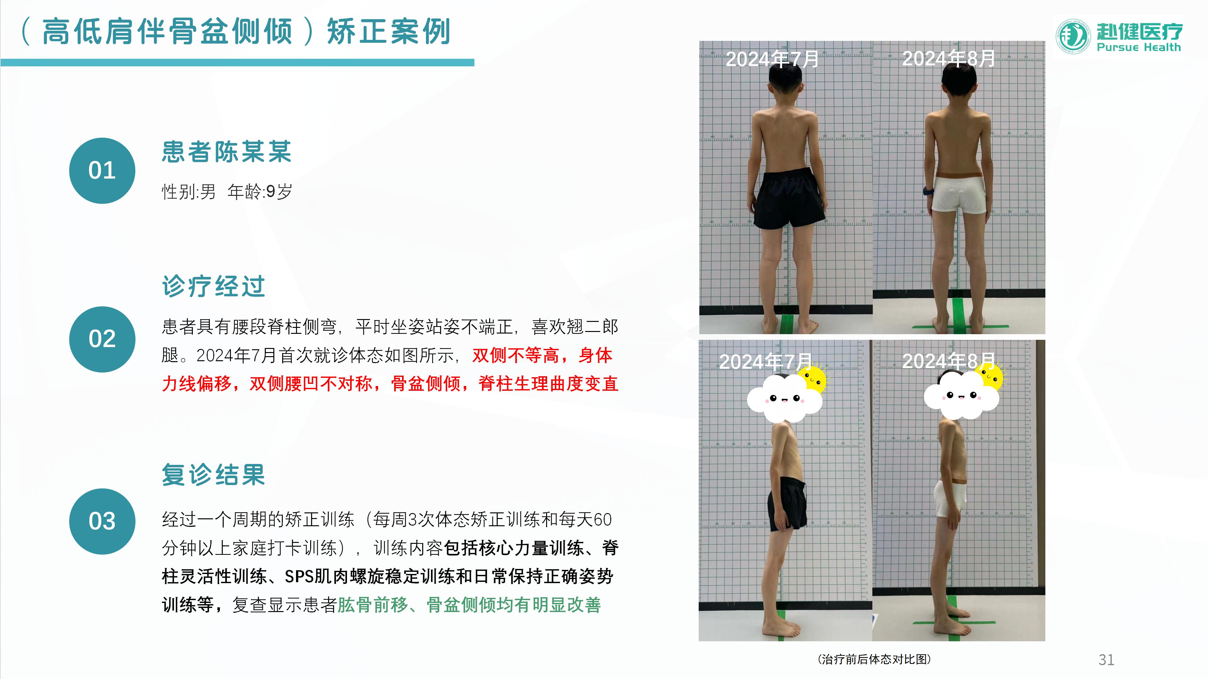 （高低肩伴骨盆侧倾）矫正案例