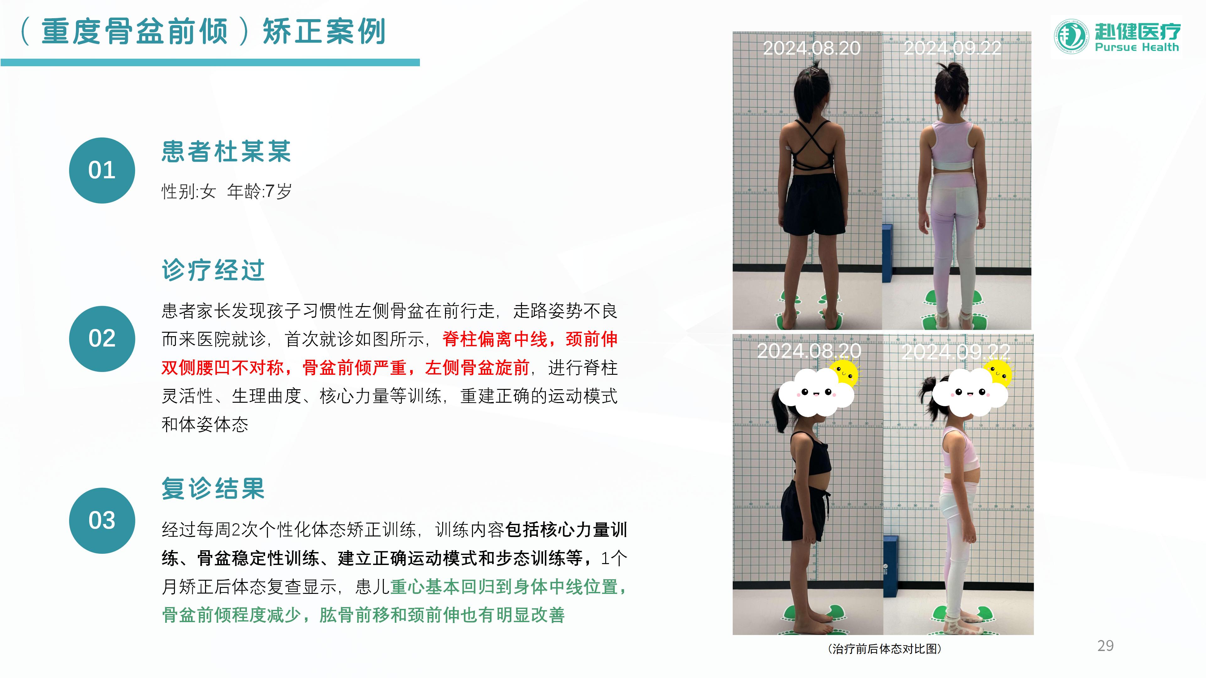 （重度骨盆前倾）矫正案例