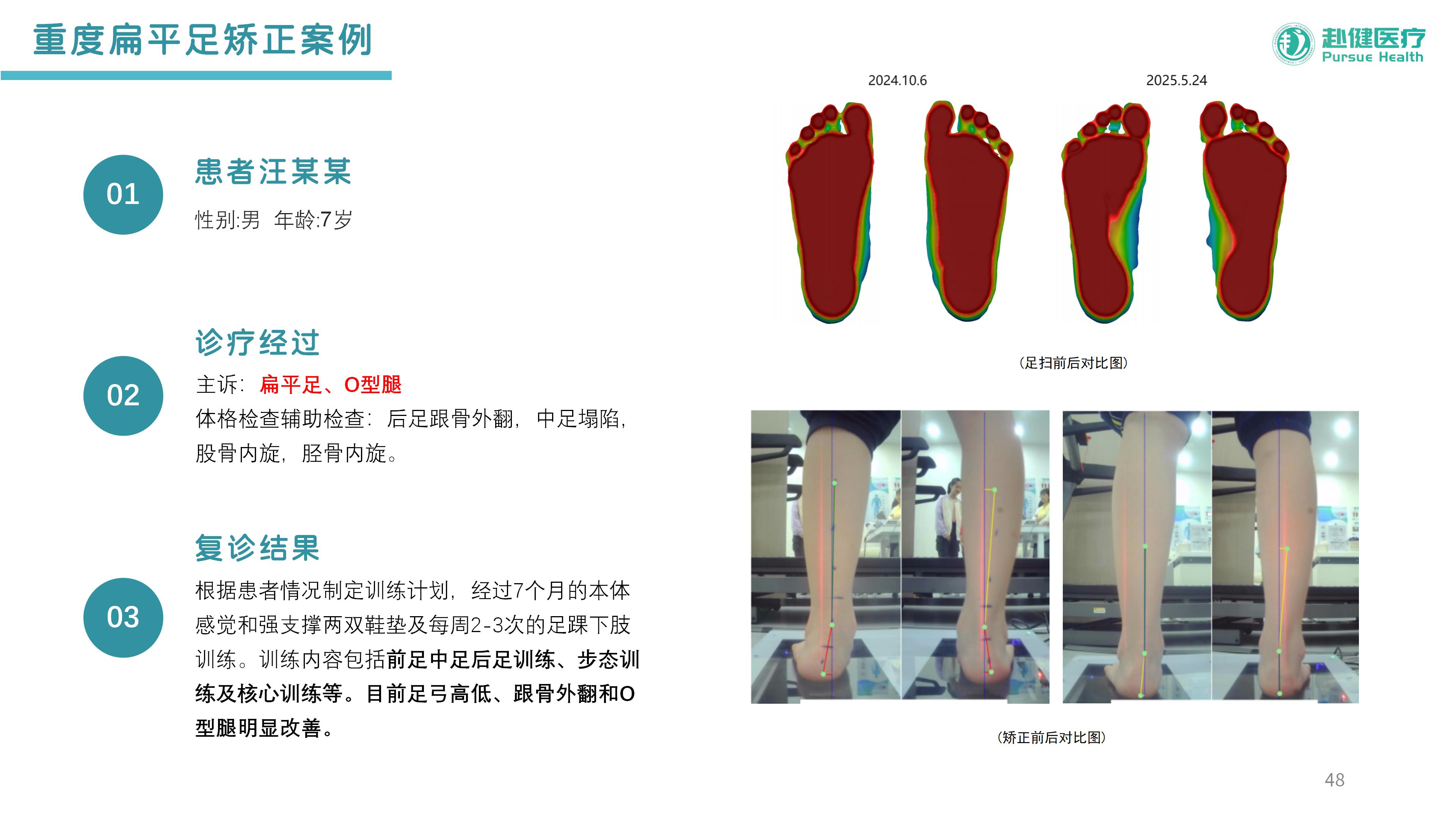 重度扁平足矫正案例