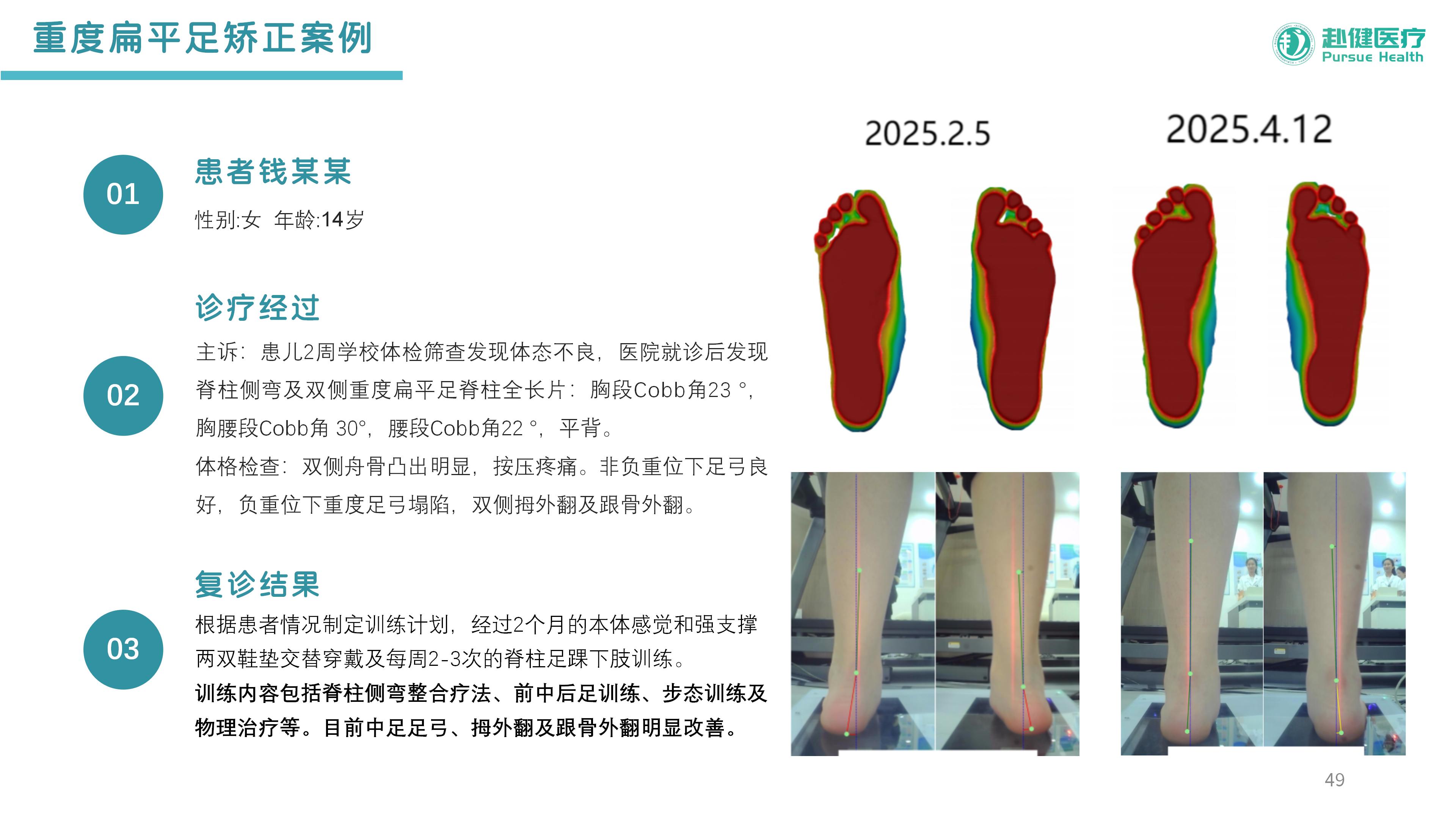 重度扁平足矫正案例