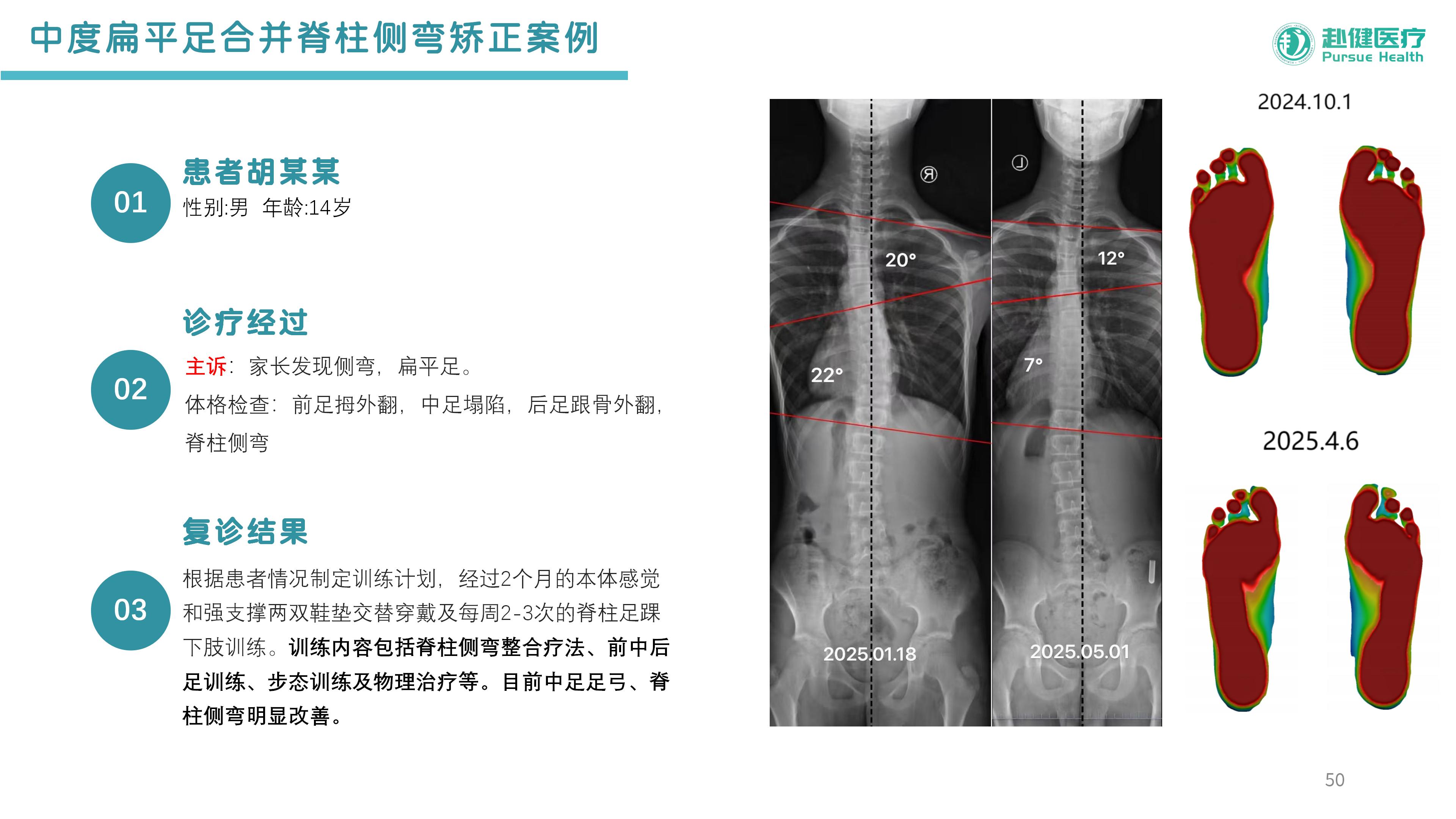 中度扁平足合并脊柱侧弯矫正案例