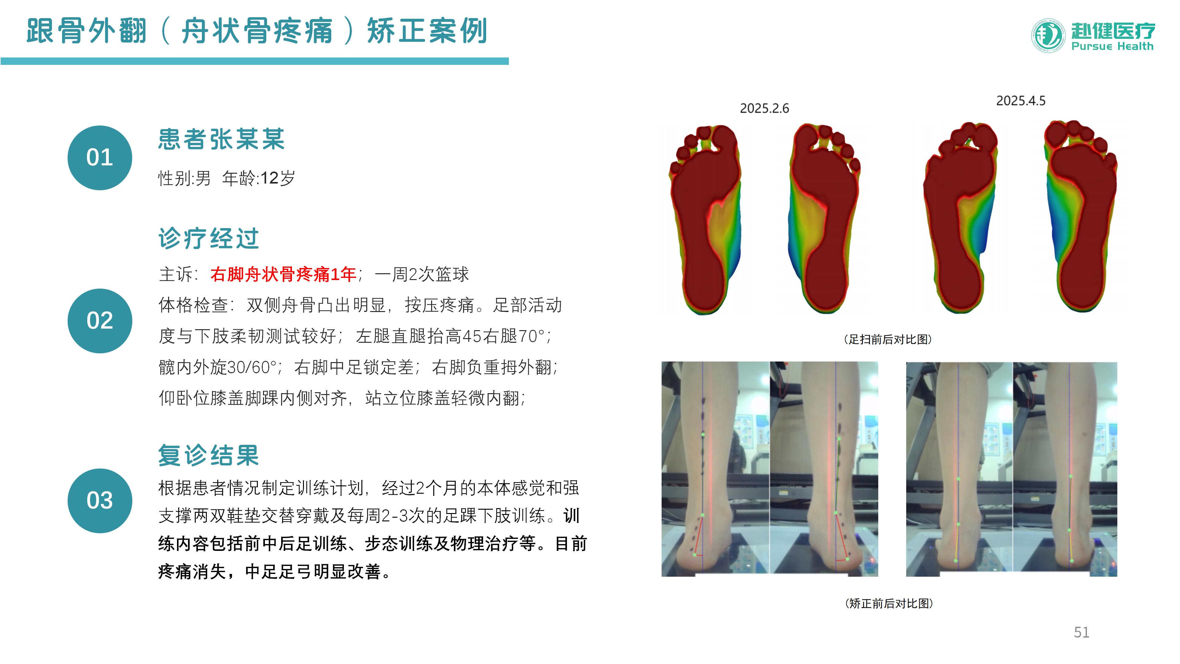 跟骨外翻（舟状骨疼痛）矫正案例