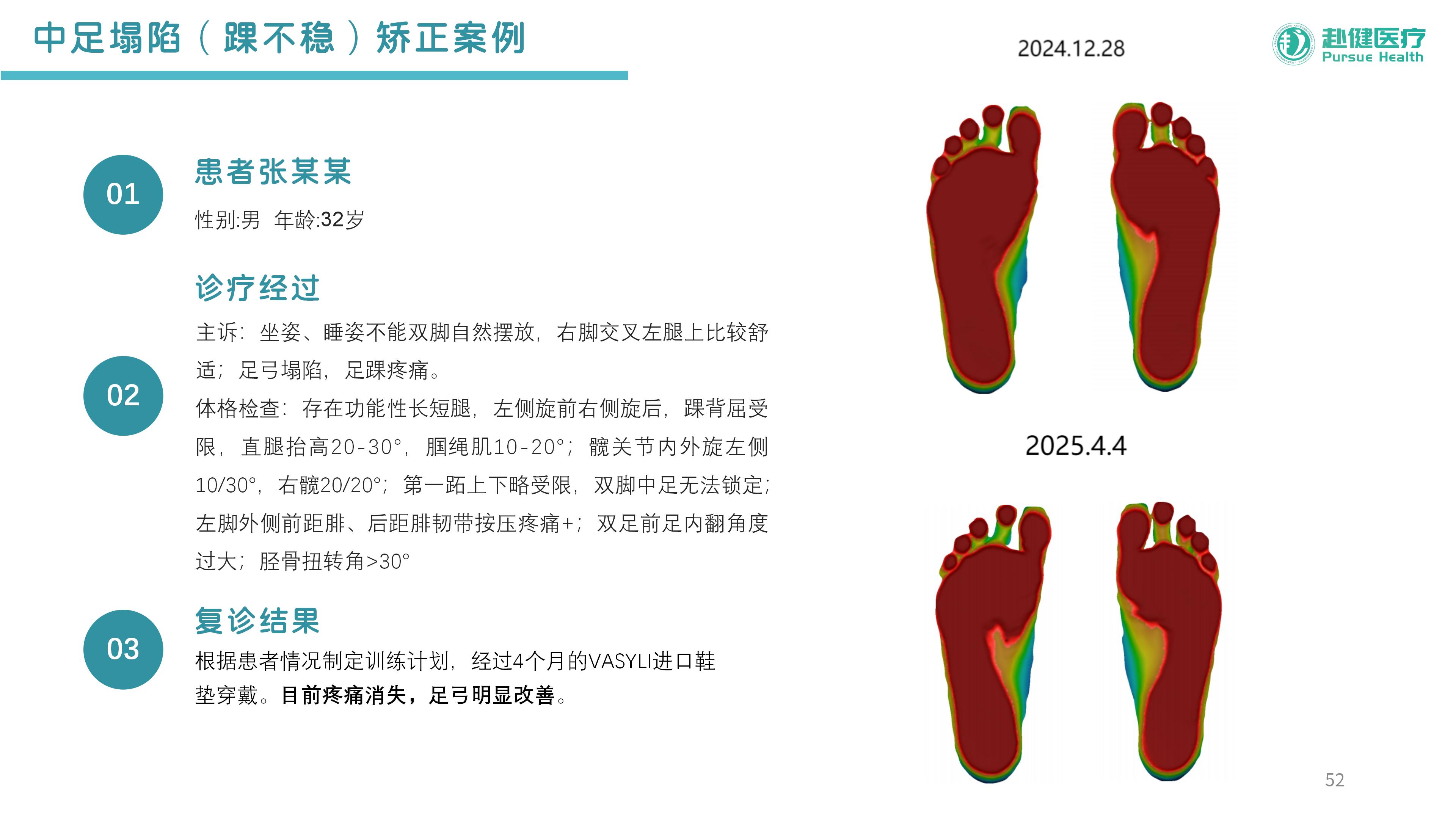 中足塌陷（踝不稳）矫正案例